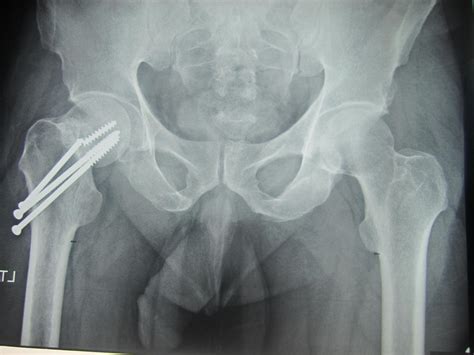 hip hemiarthroplasty orthobullets|Femoral Neck Fractures .